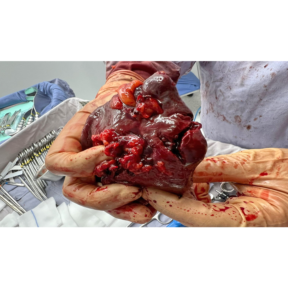 Ruptura espontánea de bazo_resección esplénica