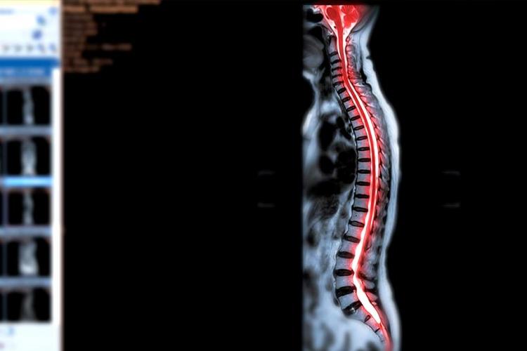 Avances en el tratamiento de la lesión de médula espinal
